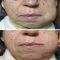 hypnosis for dental phobia