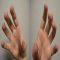 treatment dermatologic disorders