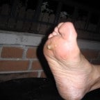 warts cured by hypnosis